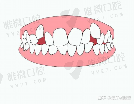 六龄齿上牙需要窝沟封闭吗,在什么情况下要做窝沟封闭(图1)